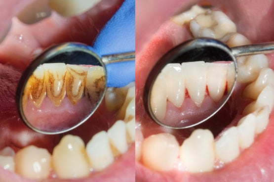 Harga Scaling Gigi Di Klinik Kerajaan