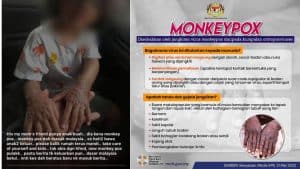 monkeypox malaysia kkm