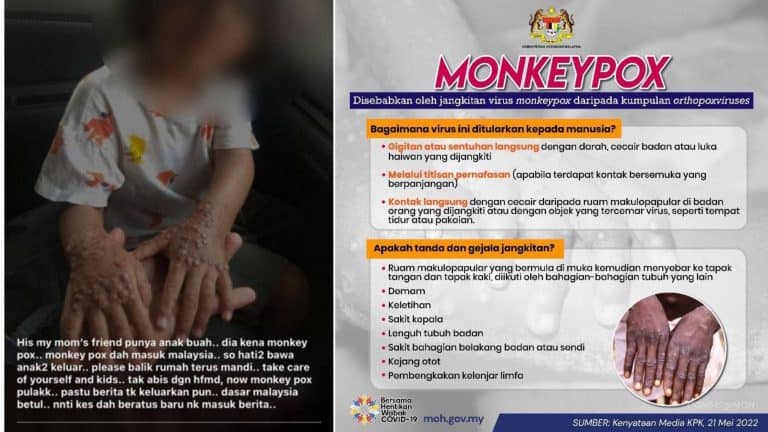 monkeypox malaysia kkm