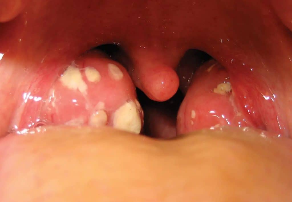 Tonsil Bengkak