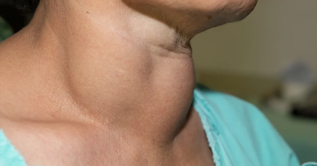 10 tanda thyroid