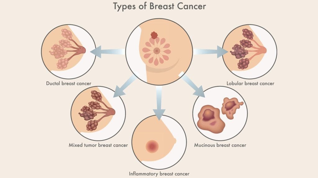 tanda kanser payudara