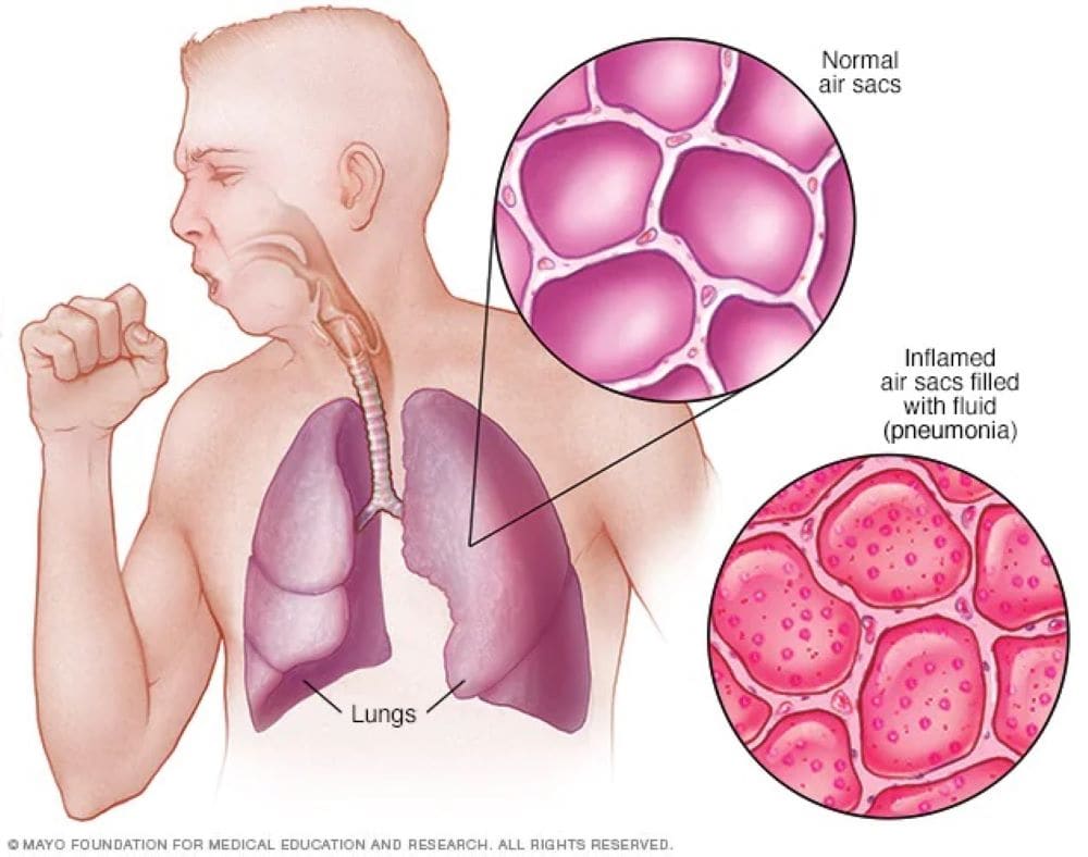 jangkitan kuman paru-paru