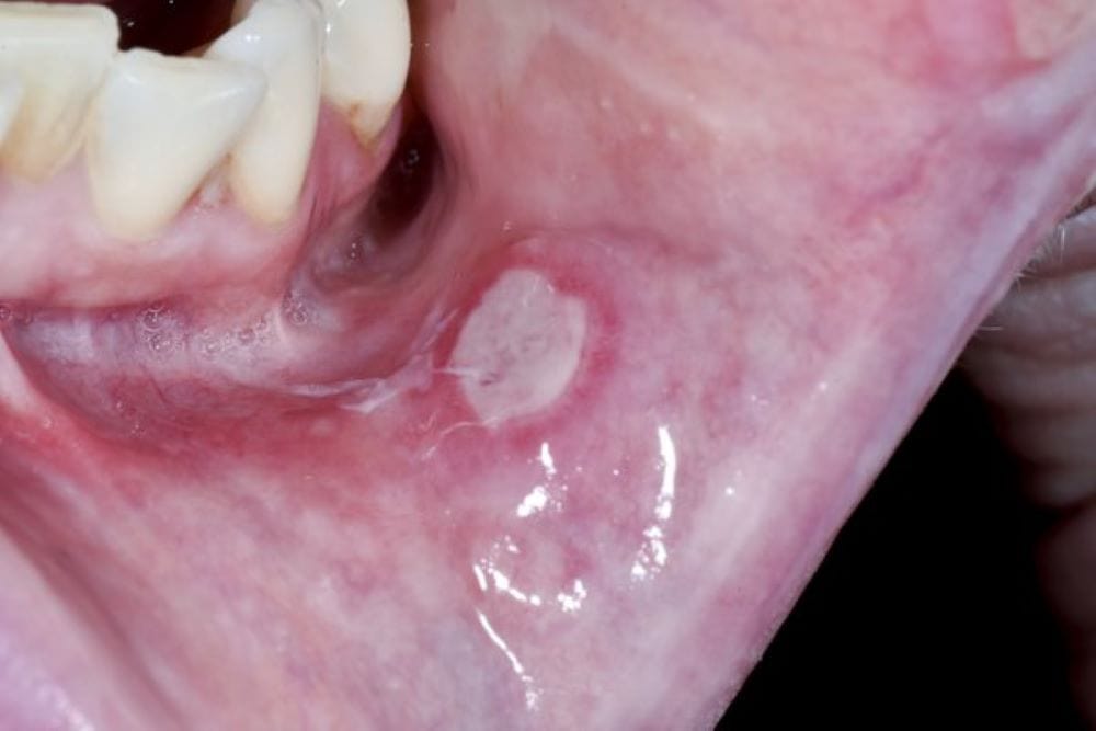cara hilangkan ulser mulut