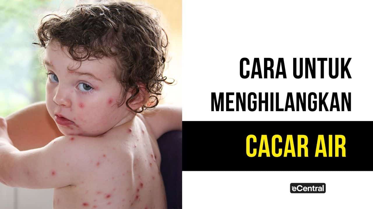 Cacar Air: Gejala, Penyebab & Rawatan Yang Sesuai