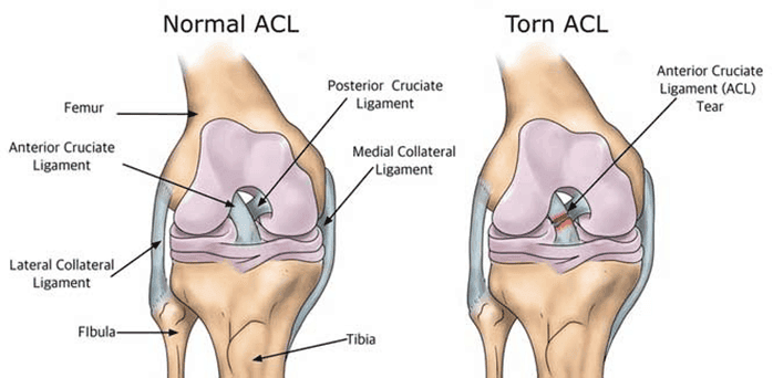  kecederaan ACL