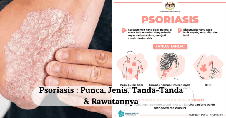 psoriasis