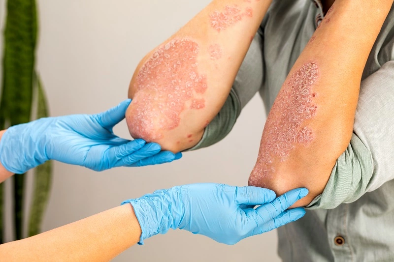 psoriasis