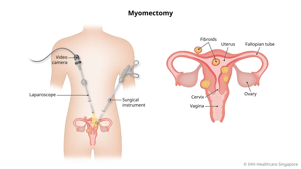 fibroid maksud