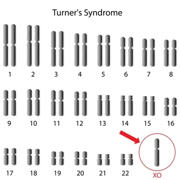 sindrom turner