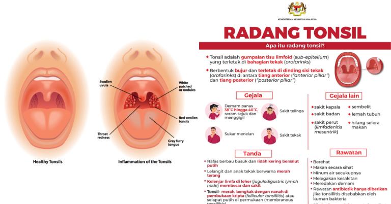 ubat tonsil