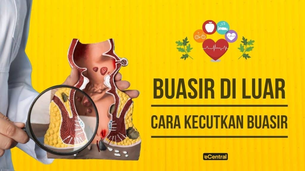 cara nak kecutkan buasir luar
