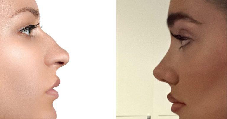 hidung mancung