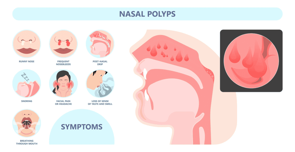 Polip Hidung, Bahaya ke? - Penyebab, Simptom & Rawatan