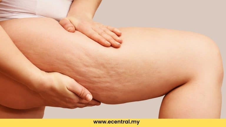 cara hilangkan selulit