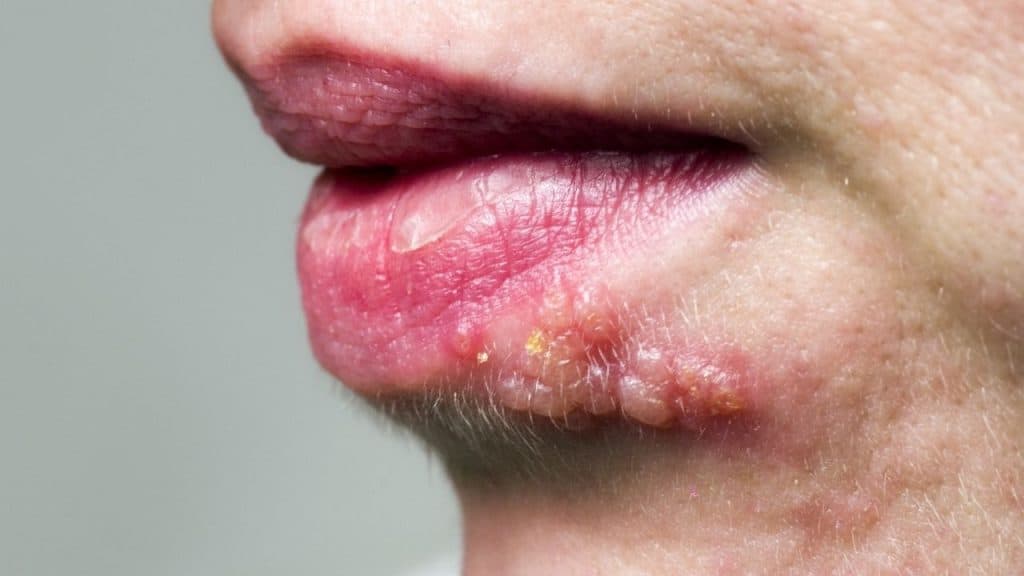 herpes