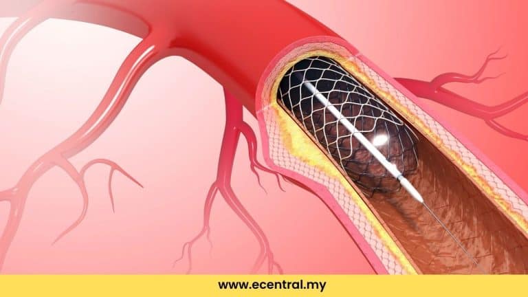 stent jantung